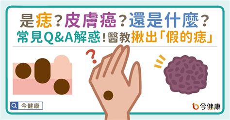 痣 凸起來|是痣or皮膚癌？醫「1張圖秒對照」 長這2部位最危險